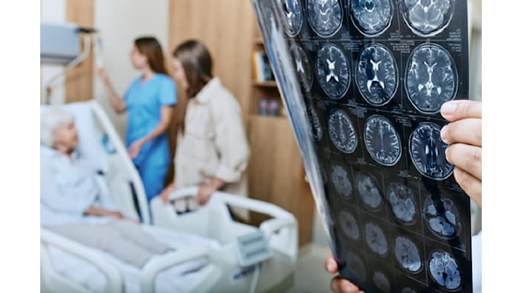 Prevenzione della demenza: le nuove linee guida Oms 2026 - Nurse24.it