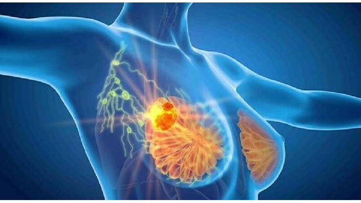 Tumore al seno, la svolta del test genetico. «Milioni di donne eviteranno la chemioterapia» - Il Messaggero