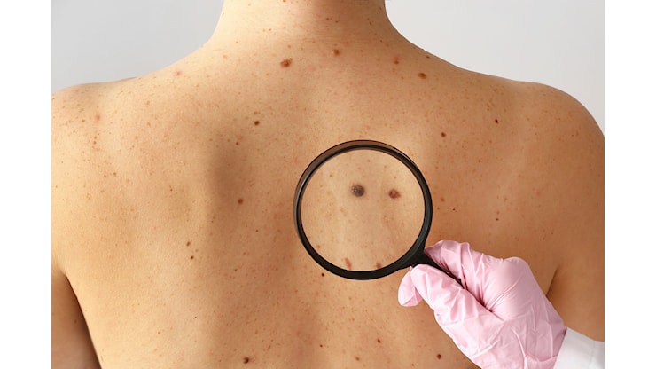 “Save your Skin” al Policlinico di Messina: il 23 Maggio visite gratuite a dermatologia - Normanno.com